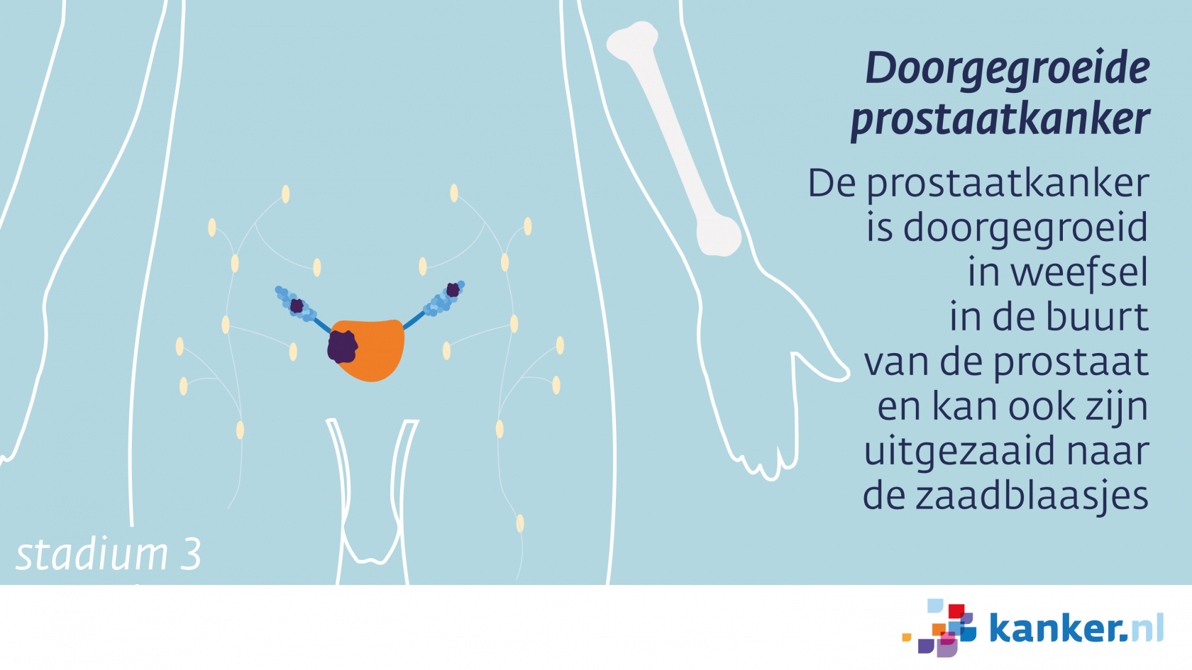 Het stadium van prostaatkanker Kanker.nl